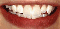 Tooth Bonding