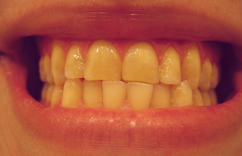 bruxism bruxism