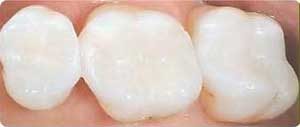 Composite Tooth Fillings