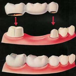 Dental Bridge Illustration