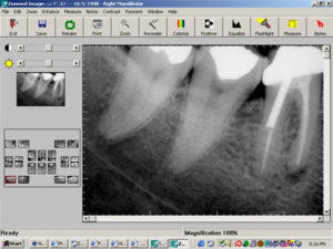 Digital Dental X-Ray
