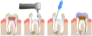 Root Canal Therapy Diagram