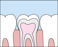 Tooth Sealants